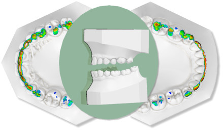 Deltaface, ArchForm, ONYXCEPH, 3Shape Ortho System, 3Shape Clear Aligner Studio, NemoCast, Nemotec, Ortho X Aligner, diorco, dentOne, 3dLeone, 3D Leone Designer, SureSmile Aligner, ulab, ulabsystems, blue sky bio, Maestro 3D, M3D, AGE Solutions, MDS500, Best orthodontic software, Bracket placement software, Digital study models, Rapid prototyping for dentistry, 3D scanner for jewelry, Dental scanner, Best dental scanner, Orthodontic software for clear aligners, Digital design of clear aligners, Orthodontic CAD/CAM software, Rapid prototyping for orthodontics, Guide for aligner production, Dental aligner software solutions, Digital creation of orthodontic appliances, 3D modeling for dental aligners, Direct 3D printing of clear aligners, Orthodontic correction software, Advanced technology for aligners, Software for expander design, Automatic aligner cutting, Ortho Studio Software, Dental Studio Software, Digital bands and expanders, Digital bite splint, Digital mouthguard, AI-based automatic tooth segmentation, AI-based digital orthodontics, Orthodontic treatment software, AI-powered dental aligner software, AI-driven digital dental aligners, AI software solutions for dental aligners, AI technology for orthodontic correction, AI-based orthodontic planning, Cloud-based dental aligner software, Cloud solutions for orthodontics, Web viewer for orthodontic cases, Lingual Holding Appliance (LLHA), Trans-Palatal Arch (TPA)