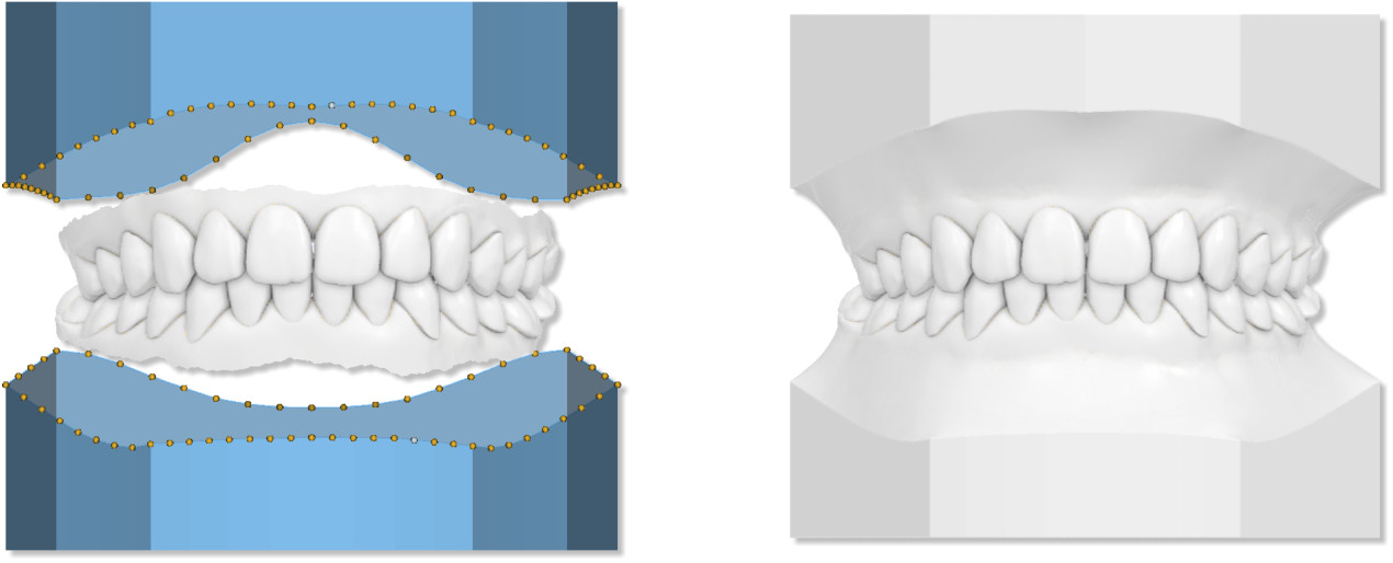 Deltaface, ArchForm, ONYXCEPH, 3Shape Ortho System, 3Shape Clear Aligner Studio, NemoCast, Nemotec, Ortho X Aligner, diorco, dentOne, 3dLeone, 3D Leone Designer, SureSmile Aligner, ulab, ulabsystems, blue sky bio, Maestro 3D, M3D, AGE Solutions, MDS500, Best orthodontic software, Bracket placement software, Digital study models, Rapid prototyping for dentistry, 3D scanner for jewelry, Dental scanner, Best dental scanner, Orthodontic software for clear aligners, Digital design of clear aligners, Orthodontic CAD/CAM software, Rapid prototyping for orthodontics, Guide for aligner production, Dental aligner software solutions, Digital creation of orthodontic appliances, 3D modeling for dental aligners, Direct 3D printing of clear aligners, Orthodontic correction software, Advanced technology for aligners, Software for expander design, Automatic aligner cutting, Ortho Studio Software, Dental Studio Software, Digital bands and expanders, Digital bite splint, Digital mouthguard, AI-based automatic tooth segmentation, AI-based digital orthodontics, Orthodontic treatment software, AI-powered dental aligner software, AI-driven digital dental aligners, AI software solutions for dental aligners, AI technology for orthodontic correction, AI-based orthodontic planning, Cloud-based dental aligner software, Cloud solutions for orthodontics, Web viewer for orthodontic cases, Lingual Holding Appliance (LLHA), Trans-Palatal Arch (TPA)