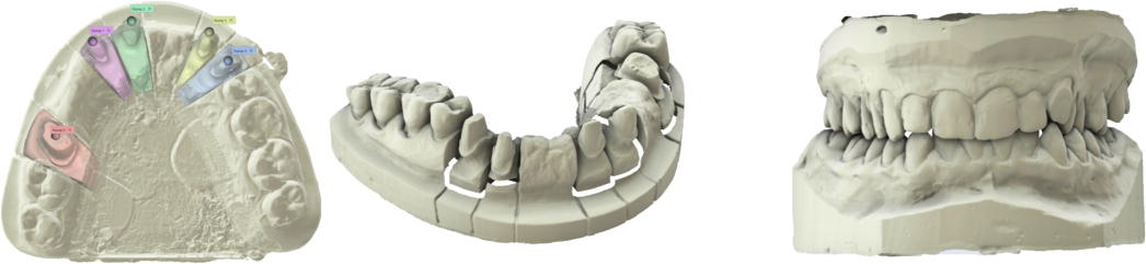 Deltaface, ArchForm, ONYXCEPH, 3Shape Ortho System, 3Shape Clear Aligner Studio, NemoCast, Nemotec, Ortho X Aligner, diorco, dentOne, 3dLeone, 3D Leone Designer, SureSmile Aligner, ulab, ulabsystems, blue sky bio, Maestro 3D, M3D, AGE Solutions, MDS500, Miglior software per ortodontia, Software per posizionamento Brackets, Modelli studio digitali, Prototipazione rapida per odontoiatria, 3D Scanner per gioielleria, Scanner Dentale, Miglior Scanner Dentale, Software ortodontico per allineatori trasparenti, Progettazione digitale di allineatori trasparenti, Software CAD/CAM ortodontico, Prototipazione rapida per ortodonzia, Guida per la produzione di allineatori, Soluzioni software per allineatori dentali, Creazione digitale di apparecchi ortodontici, Modellazione 3D per allineatori dentali, Stampa 3D diretta di allineatori trasparenti, Software per la correzione ortodontica, Tecnologia avanzata per allineatori, Software per la progettazione di espansori, Taglio automatico degli allineatori, Ortho Studio Software, Dental Studio Software, Bande ed Espansori Digitali, Bite-splint digitale, Paradenti digitale, Segmentazione automatica dei denti basata su Intelligenza Artificiale, Ortodonzia digitale basata su Intelligenza Artificiale, Software per il trattamento ortodontico, Software per allineatori dentali con intelligenza artificiale, Allineatori dentali digitali AI, Soluzioni software AI per allineatori dentali, Tecnologia AI per la correzione ortodontica Pianificazione ortodontica basata su intelligenza artificiale, Software per allineatori dentali basato su cloud, Soluzioni cloud per ortodonzia, Web viewer di casi ortodontici, Lingual Holding Appliance (LLHA), Trans-Palatal Arch (TPA)