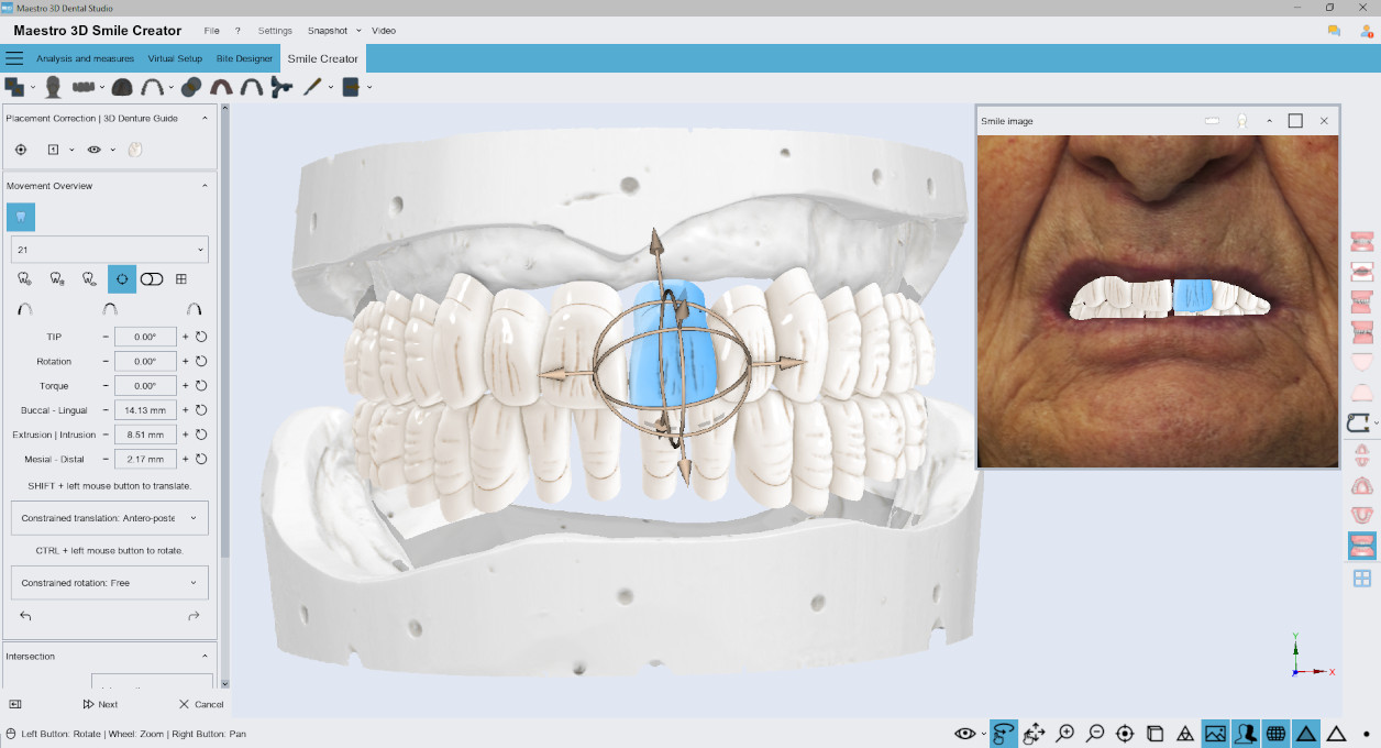 Deltaface, ArchForm, ONYXCEPH, 3Shape Ortho System, 3Shape Clear Aligner Studio, NemoCast, Nemotec, Ortho X Aligner, diorco, dentOne, 3dLeone, 3D Leone Designer, SureSmile Aligner, ulab, ulabsystems, blue sky bio, Maestro 3D, M3D, AGE Solutions, MDS500, Beste kieferorthopädische Software, Software für die Bracketplatzierung, Digitale Studienmodelle, Schnellprototypen für die Zahnmedizin, 3D-Scanner für Schmuck, Dental-Scanner, Bester Dental-Scanner, Kieferorthopädische Software für klare Aligner, Digitales Design von klaren Alignern, Kieferorthopädische CAD/CAM-Software, Schnellprototypen für Kieferorthopädie, Anleitung zur Aligner-Produktion, Softwarelösungen für zahnärztliche Aligner, Digitale Herstellung von kieferorthopädischen Geräten, 3D-Modellierung für zahnärztliche Aligner, Direkter 3D-Druck von klaren Alignern, Kieferorthopädische Korrektursoftware, Fortgeschrittene Technologie für Aligner, Software für Expander-Design, Automatischer Aligner-Zuschnitt, Ortho Studio Software, Dental Studio Software, Digitale Bänder und Expander, Digitale Biss-Schiene, Digitale Mundschutz, KI-basierte automatische Zahnsegmentierung, KI-basierte digitale Kieferorthopädie, Kieferorthopädische Behandlungssoftware, KI-gesteuerte Software für zahnärztliche Aligner, KI-gesteuerte digitale zahnärztliche Aligner, KI-Softwarelösungen für zahnärztliche Aligner, KI-Technologie für kieferorthopädische Korrektur, KI-basierte kieferorthopädische Planung, Cloud-basierte Software für zahnärztliche Aligner, Cloud-Lösungen für Kieferorthopädie, Webviewer für kieferorthopädische Fälle, Lingual Holding Appliance (LLHA), Trans-Palatal Arch (TPA)