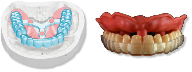 Deltaface, ArchForm, ONYXCEPH, 3Shape Ortho System, 3Shape Clear Aligner Studio, NemoCast, Nemotec, Ortho X Aligner, diorco, dentOne, 3dLeone, 3D Leone Designer, SureSmile Aligner, ulab, ulabsystems, blue sky bio, Maestro 3D, M3D, AGE Solutions, MDS500, Miglior software per ortodontia, Software per posizionamento Brackets, Modelli studio digitali, Prototipazione rapida per odontoiatria, 3D Scanner per gioielleria, Scanner Dentale, Miglior Scanner Dentale, Software ortodontico per allineatori trasparenti, Progettazione digitale di allineatori trasparenti, Software CAD/CAM ortodontico, Prototipazione rapida per ortodonzia, Guida per la produzione di allineatori, Soluzioni software per allineatori dentali, Creazione digitale di apparecchi ortodontici, Modellazione 3D per allineatori dentali, Stampa 3D diretta di allineatori trasparenti, Software per la correzione ortodontica, Tecnologia avanzata per allineatori, Software per la progettazione di espansori, Taglio automatico degli allineatori, Ortho Studio Software, Dental Studio Software, Bande ed Espansori Digitali, Bite-splint digitale, Paradenti digitale, Segmentazione automatica dei denti basata su Intelligenza Artificiale, Ortodonzia digitale basata su Intelligenza Artificiale, Software per il trattamento ortodontico, Software per allineatori dentali con intelligenza artificiale, Allineatori dentali digitali AI, Soluzioni software AI per allineatori dentali, Tecnologia AI per la correzione ortodontica Pianificazione ortodontica basata su intelligenza artificiale, Software per allineatori dentali basato su cloud, Soluzioni cloud per ortodonzia, Web viewer di casi ortodontici, Lingual Holding Appliance (LLHA), Trans-Palatal Arch (TPA)