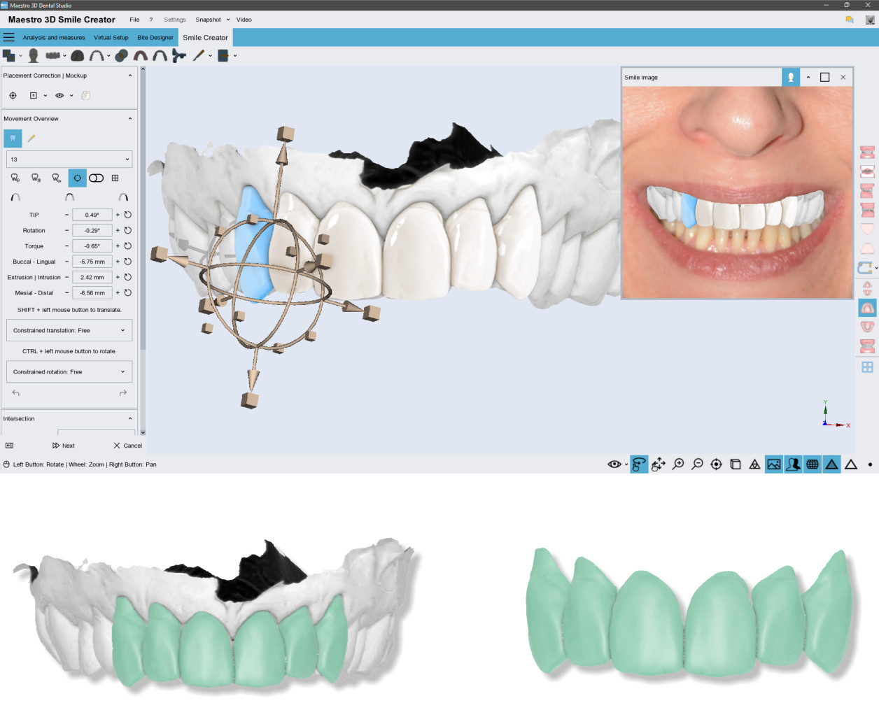 Deltaface, ArchForm, ONYXCEPH, 3Shape Ortho System, 3Shape Clear Aligner Studio, NemoCast, Nemotec, Ortho X Aligner, diorco, dentOne, 3dLeone, 3D Leone Designer, SureSmile Aligner, ulab, ulabsystems, blue sky bio, Maestro 3D, M3D, AGE Solutions, MDS500, Best orthodontic software, Bracket placement software, Digital study models, Rapid prototyping for dentistry, 3D scanner for jewelry, Dental scanner, Best dental scanner, Orthodontic software for clear aligners, Digital design of clear aligners, Orthodontic CAD/CAM software, Rapid prototyping for orthodontics, Guide for aligner production, Dental aligner software solutions, Digital creation of orthodontic appliances, 3D modeling for dental aligners, Direct 3D printing of clear aligners, Orthodontic correction software, Advanced technology for aligners, Software for expander design, Automatic aligner cutting, Ortho Studio Software, Dental Studio Software, Digital bands and expanders, Digital bite splint, Digital mouthguard, AI-based automatic tooth segmentation, AI-based digital orthodontics, Orthodontic treatment software, AI-powered dental aligner software, AI-driven digital dental aligners, AI software solutions for dental aligners, AI technology for orthodontic correction, AI-based orthodontic planning, Cloud-based dental aligner software, Cloud solutions for orthodontics, Web viewer for orthodontic cases, Lingual Holding Appliance (LLHA), Trans-Palatal Arch (TPA)