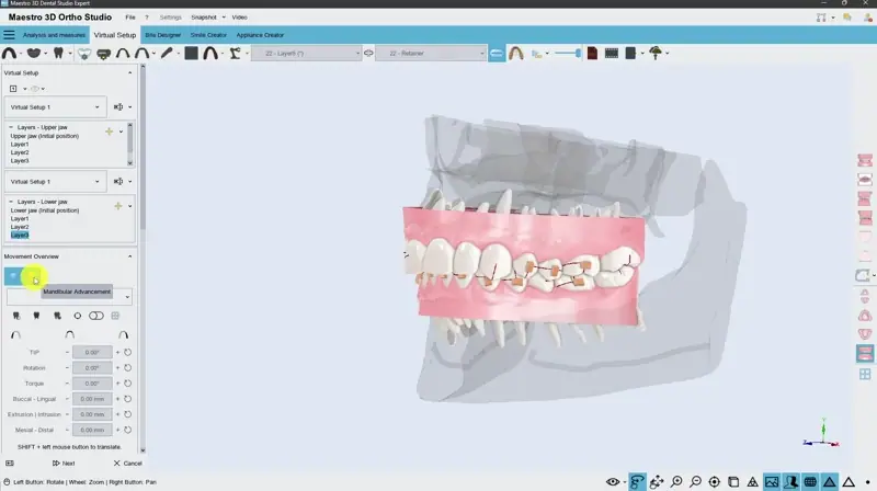 Precise control of mandibular position